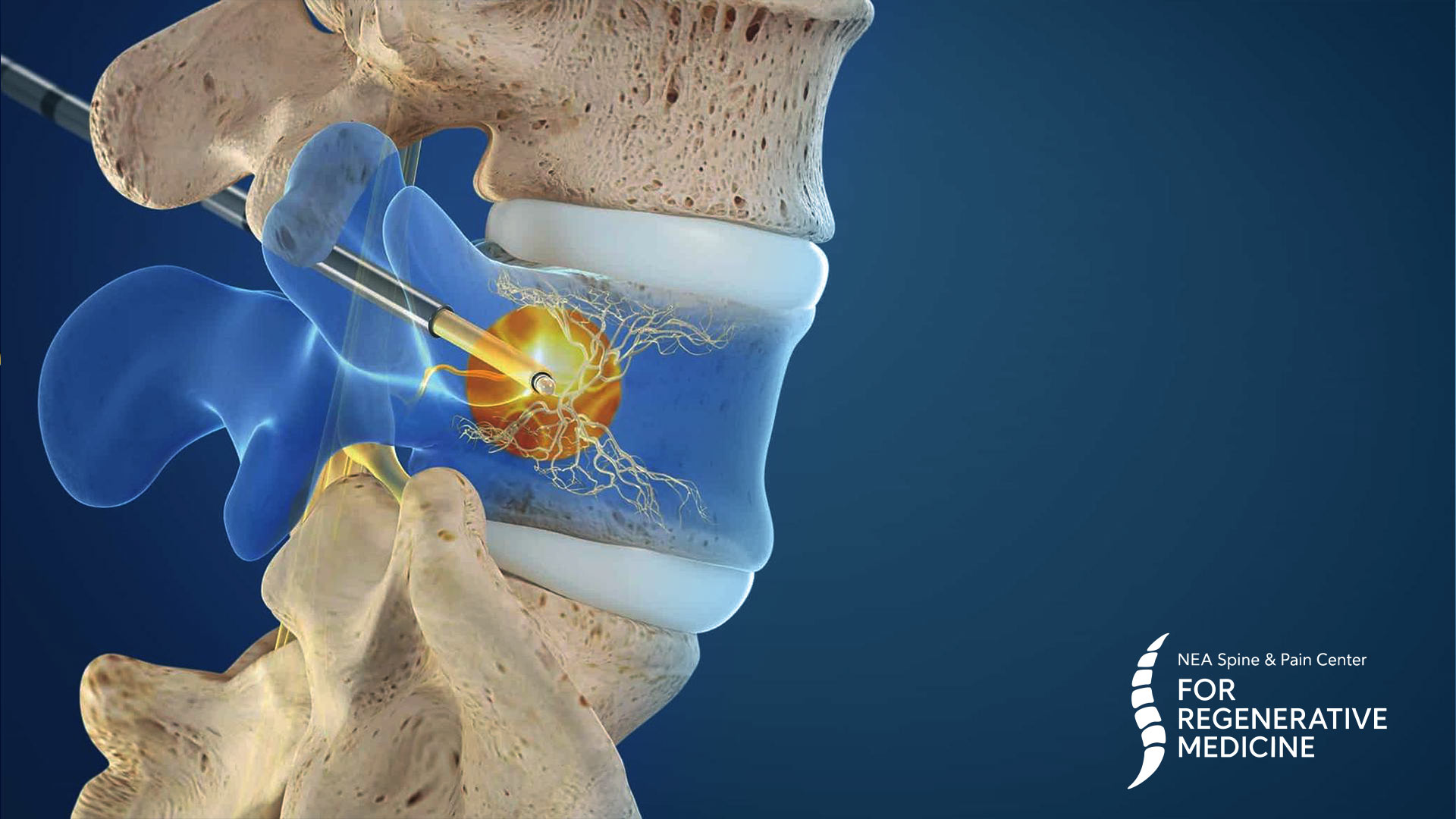 Basivertebral-nerve-ablation