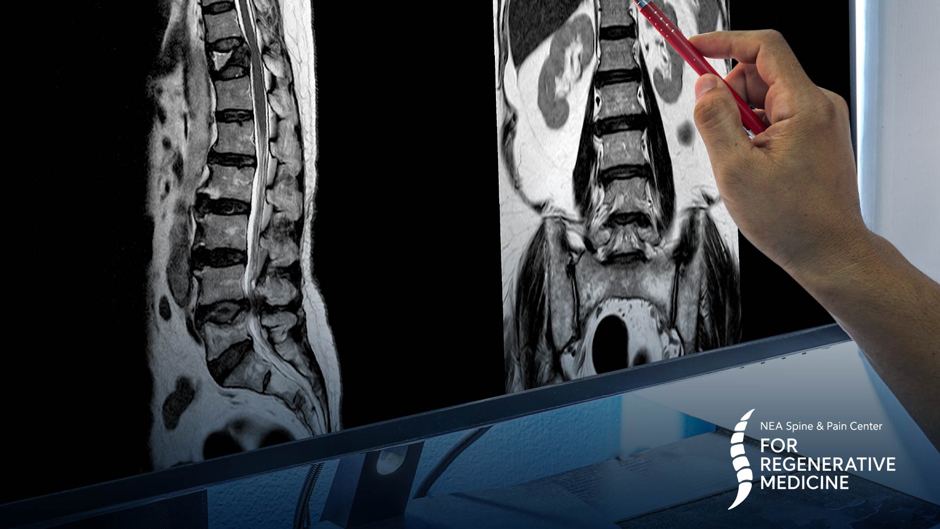 Endoscopic-Spine-Procedures