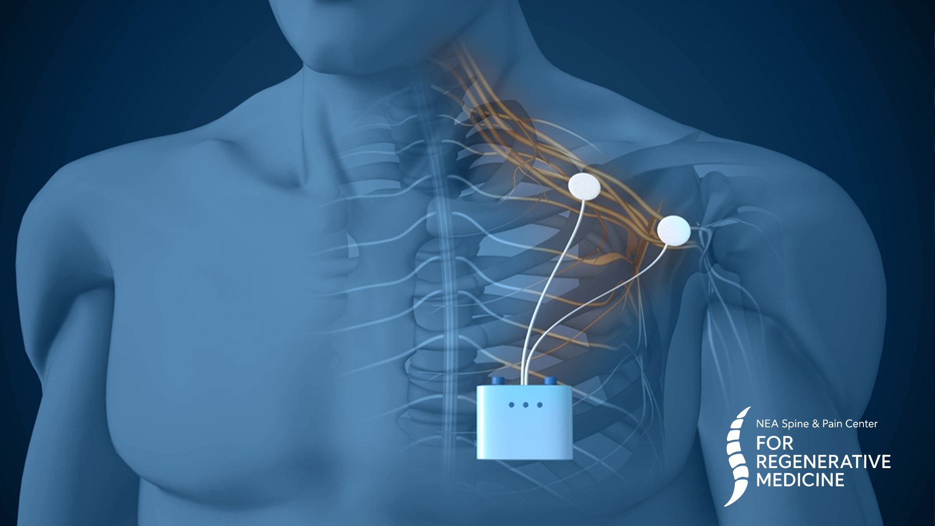 Peripheral-nerve-stimulation-implantation
