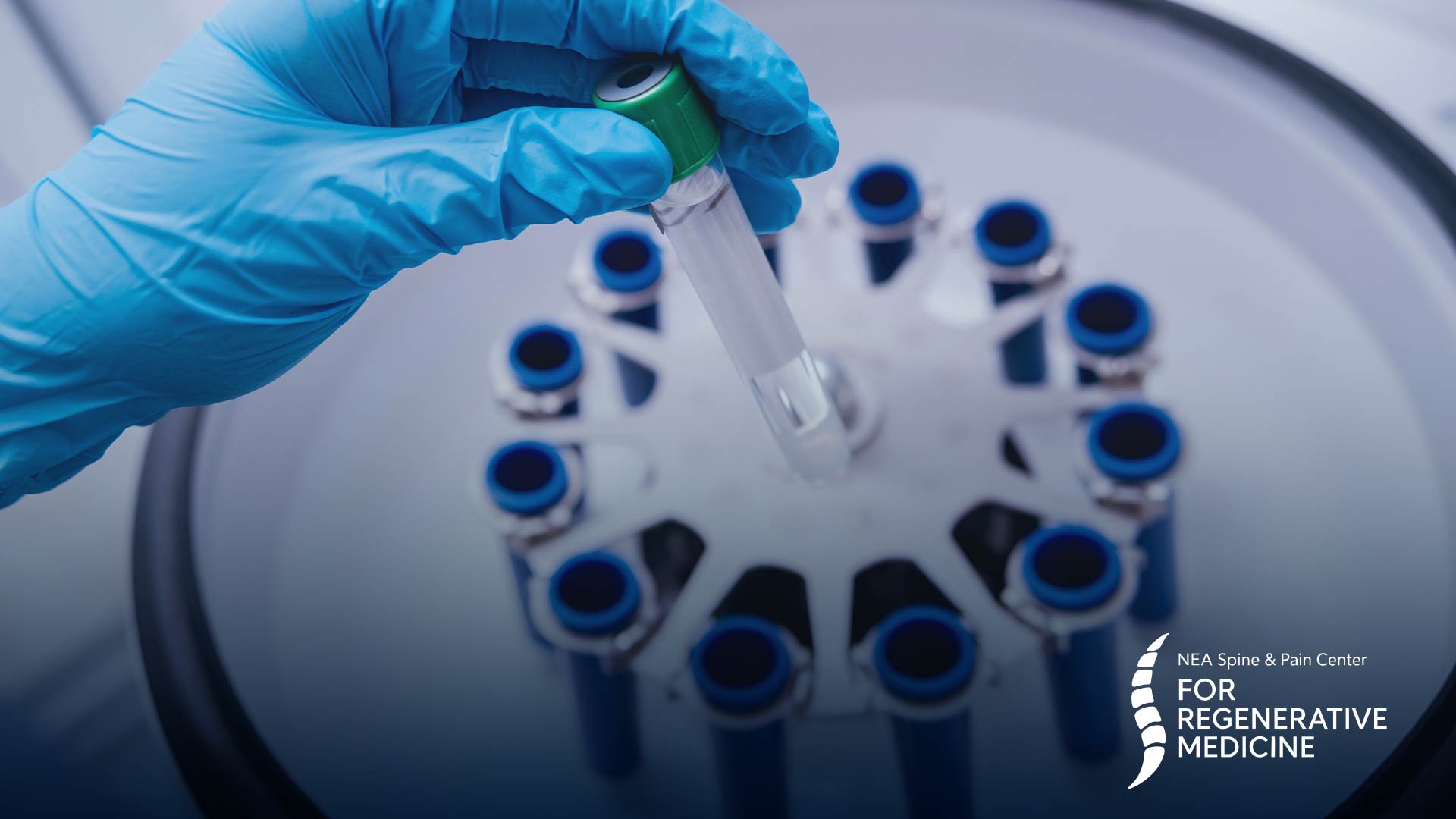 Platelet-Rich-Plasma-treatment